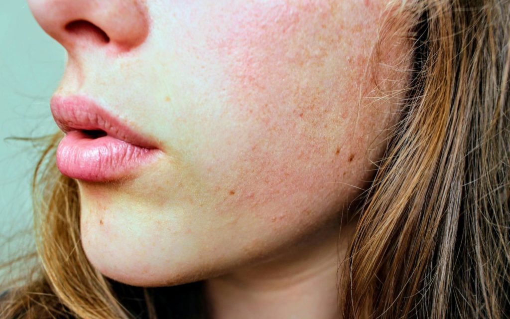 Skin Naturopath - Acne, eczema, psoriasis, dermatitis