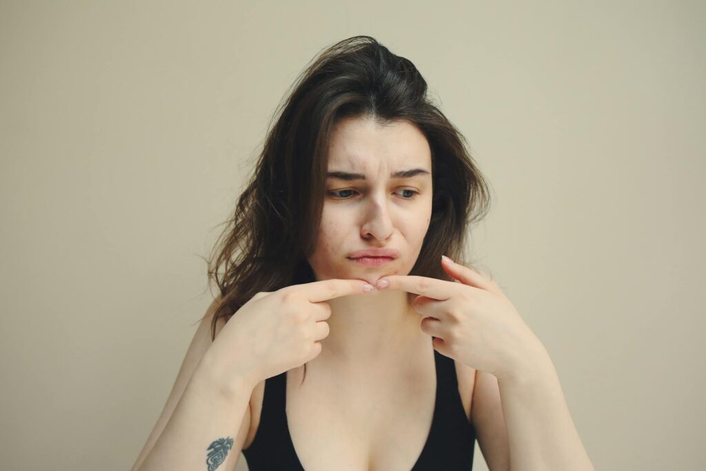 Acne Naturopath in Adelaide