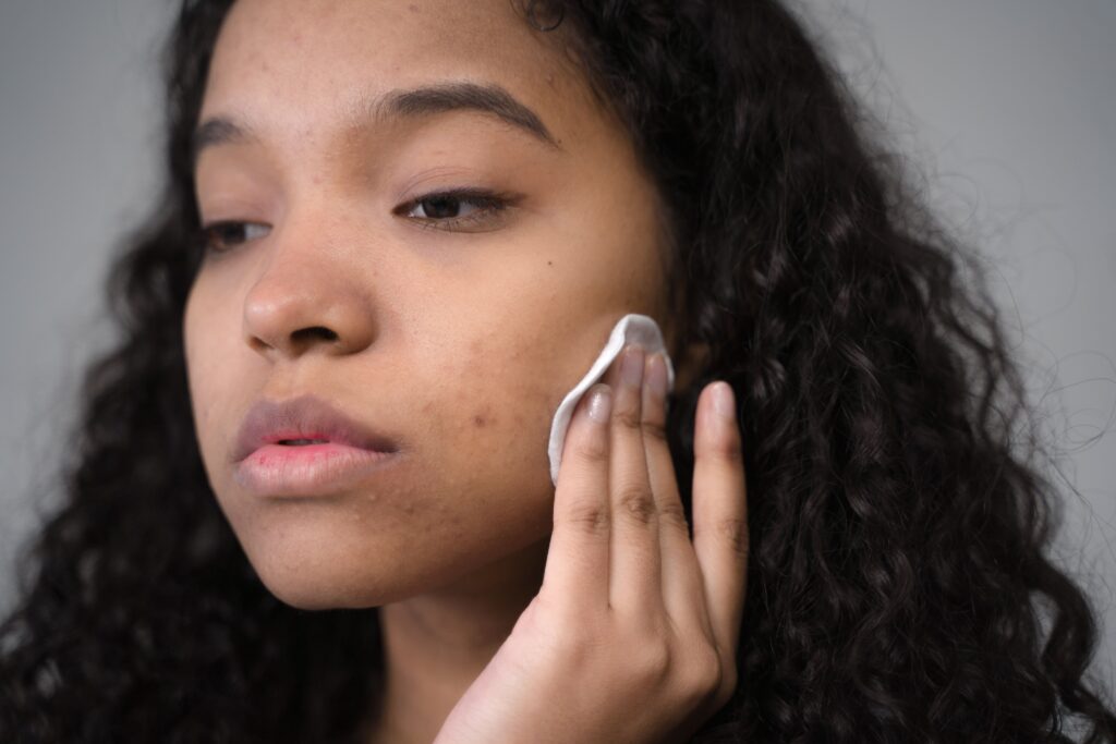 hormonal acne treatment Adelaide